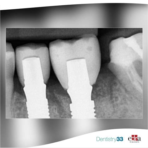 Ceramic Crown Xray at Clayton Cooper blog