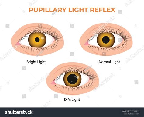 Corneal Light Reflex