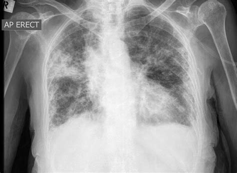 Chest X Ray Consolidation Vs Effusion at Marie Renda blog