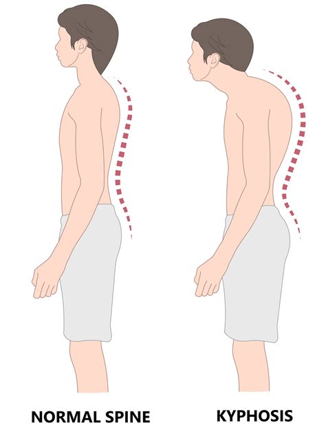 3 Health Risks from Hyperkyphosis and What You Can Do About It - Sarah Mapes