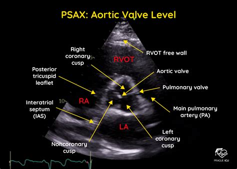 Aortic Valve Labeled Echo at Jose Orr blog
