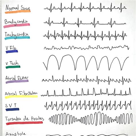 Basic ECG Rhythms 的图像结果