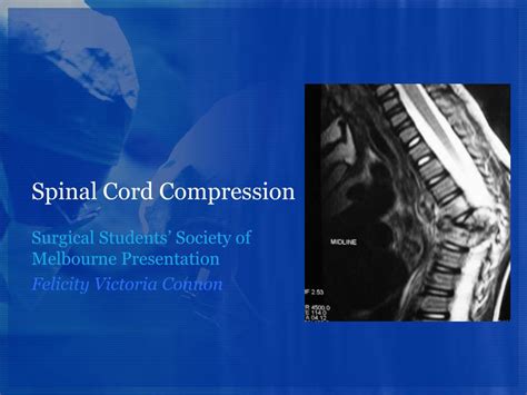 Spinal Cord Compression 的图像结果