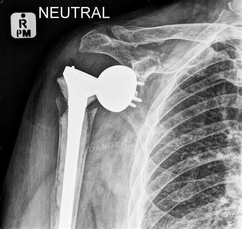Inferior Shoulder Dislocation X Ray at Jeff Updike blog