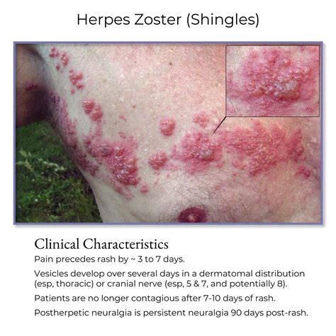 Clinical Pathology Glossary: Herpes Zoster (Shingles) | ditki medical ...