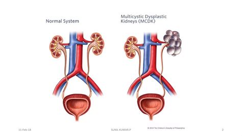 Multicystic Dysplastic Kidney