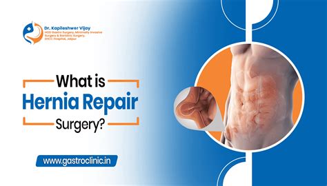 What is Hernia Repair Surgery? | Dr. Kapileshwer Vijay