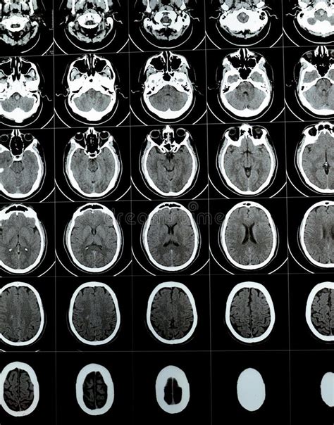 Image result for Normal Brain CT Scan Head