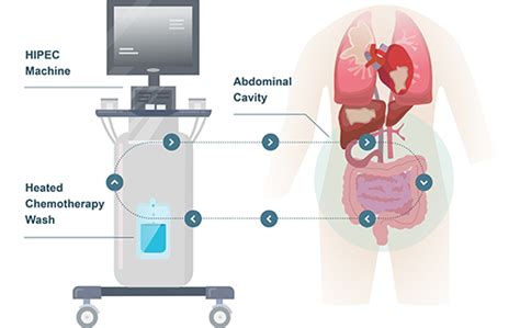 Image result for HIPEC Cartoon