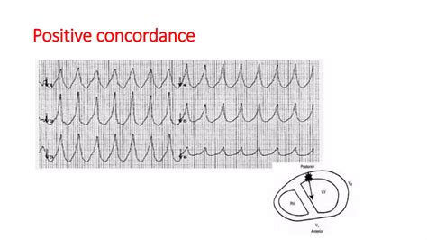 Approach to qrs wide complex tachycardias copy | PPTX | Heart and Cardiovascular Diseases ...