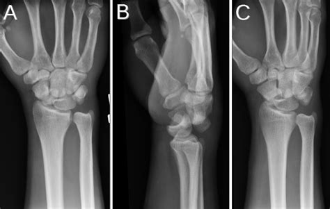 Image result for Lunate Dislocation Reduction