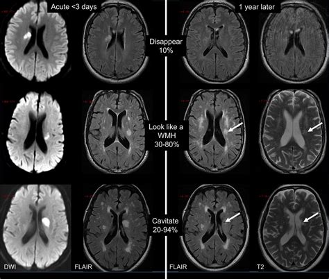 small vessel ischemic disease Cerebral csvd vascular svn bmj - Diseases Club Center 2