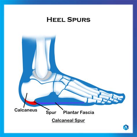 What Are Spurs In Your Heel at Kai Meany blog