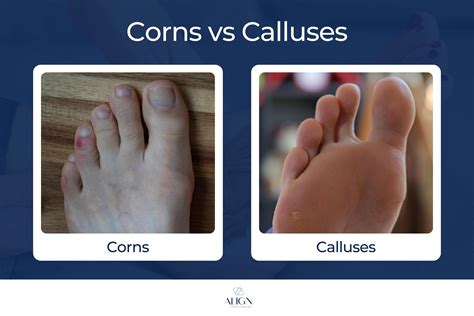 Corn & Callus Removal in Indooroopilly | Brisbane Foot Specialists ...