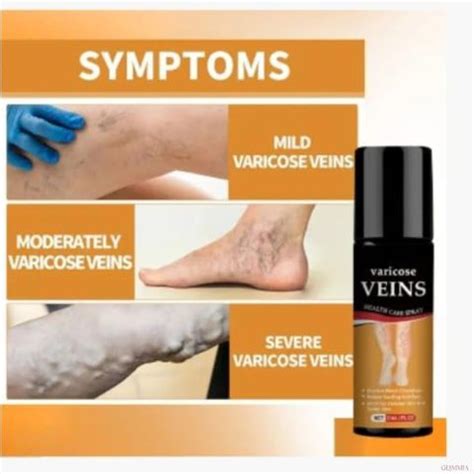 CHIWA Herbal Varicose Vein Spray - Natural Formula To Reduce Leg Strain ...