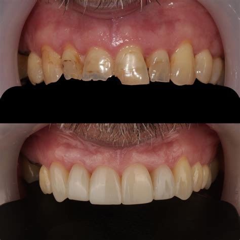 Composite Bonding – Dental Works
