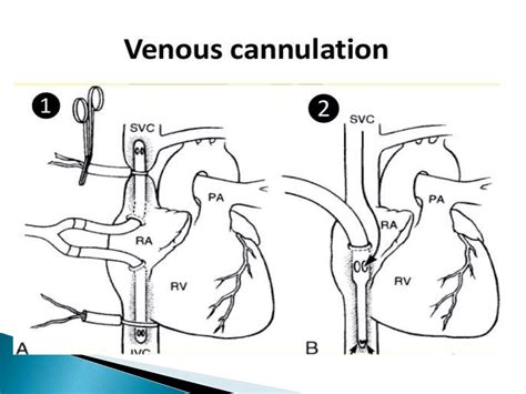 Cannulation and cardiopulmonary bypass. | PPTX