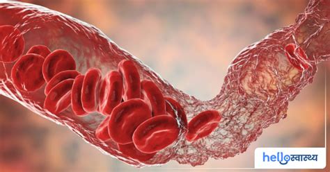 कोरोनरी आर्टरी स्पाज्म (Coronary artery spasm) क्या है? - हैलो स्वास्थ्य