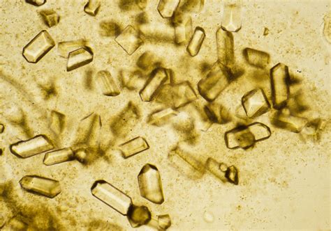 Triple Phosphate Crystals, Microscopic Analysis of Urine | Faculty of ...