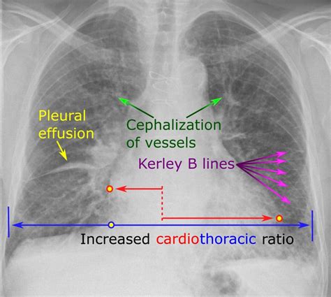 Insuficiencia Cardíaca | Concise Medical Knowledge