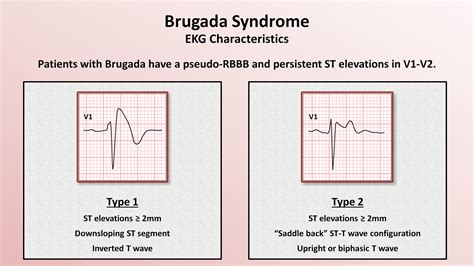 Ecg In Brugada