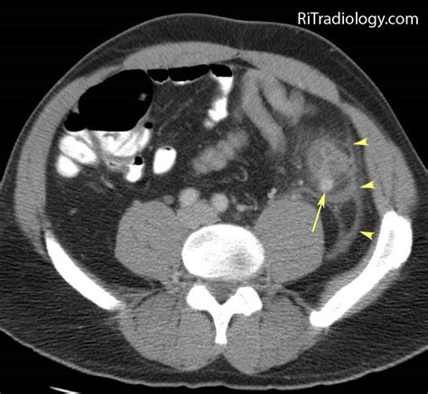 Image result for Colonic Diverticulum CT