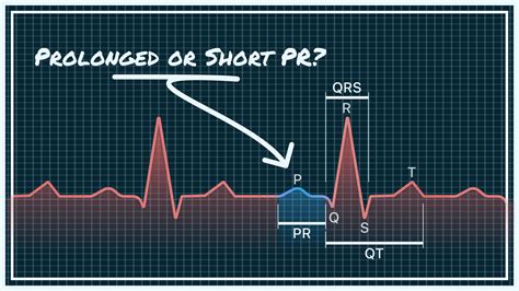 Image result for PR Interval Normal Range