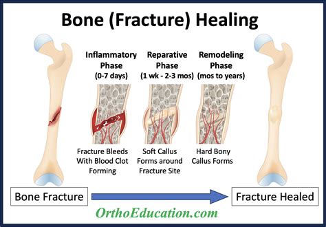 Bone Healing – Fracture Healing - OrthoEducation