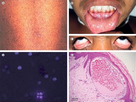 Fabry disease - A rare X-linked lysosomal storage disorder