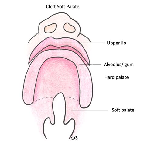 Submucous Cleft Palate Difficulty Index Based Management Of Palatal