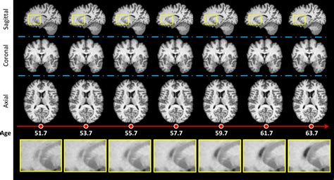Synthetic healthy brain aging MRIs with segmentation masks | doi:10.23698/aida/synthetic/shbamri ...