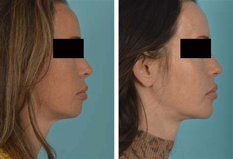 Image result for Split Case Neck