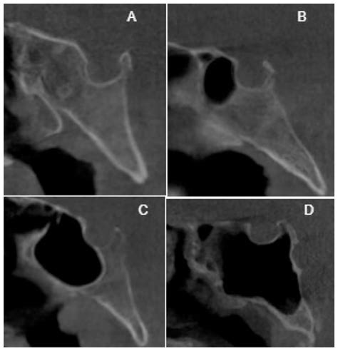Greater Wing Of Sphenoid Radiograph
