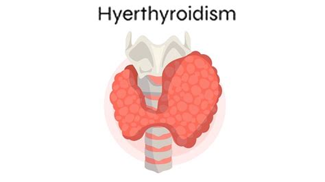Can Hyperthyroidism Cause Weight Gain? – NutritionFact.in