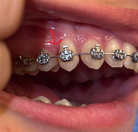 Image result for Gum Paste Pocketing