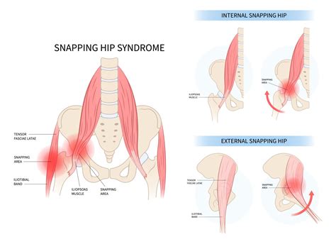 Exercises for Snapping Hip Syndrome - [P]rehab