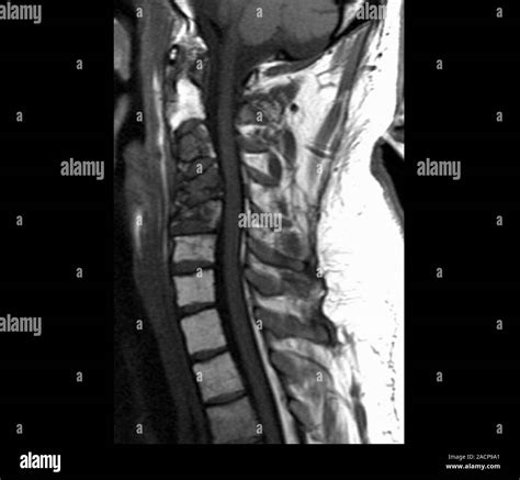 Mri Scan Of The Spine _ How to Interpret Lumbar Spine MRIs: 3 Essential Techniques – PEHHNU