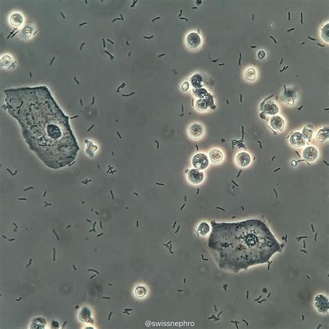 What Are Squamous Epithelial Cells In Urine at Ruby Silverman blog