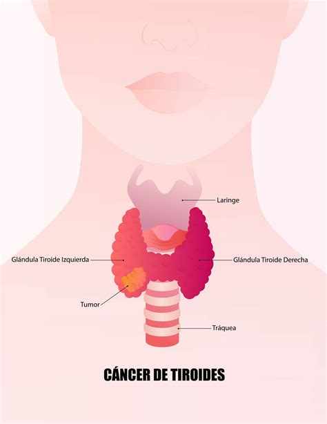 Cáncer de Tiroides