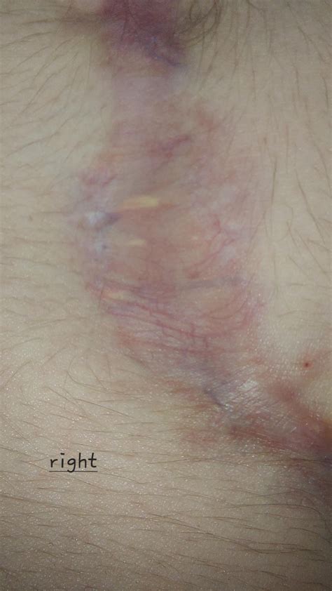 8 months post-op & hollow/sunken/cigarette paper scars : r/TopSurgery