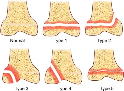 Imaging Review of Normal and Abnormal Skeletal Maturation | RadioGraphics