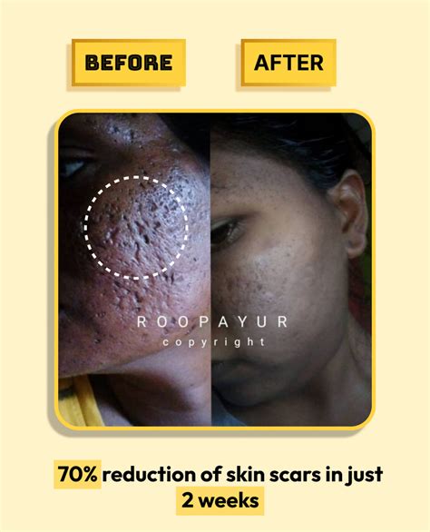 Best Acne Scar Healing Combo – Reduce Acne Pits, Dark Spots, & Shrink