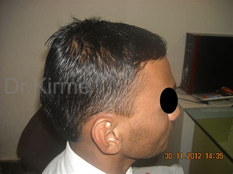 Gallery - Dr. Kirme || Hair Fall, Hair Loss, Baldness(Non-Genetic ...