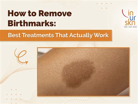 Heat Boils: What They Mean & How to Treat Them