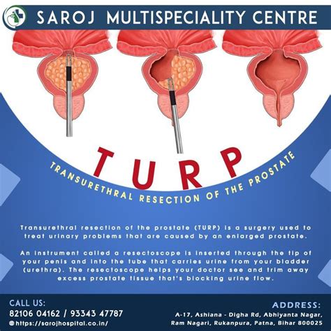 Image result for Turp Procedure Explained