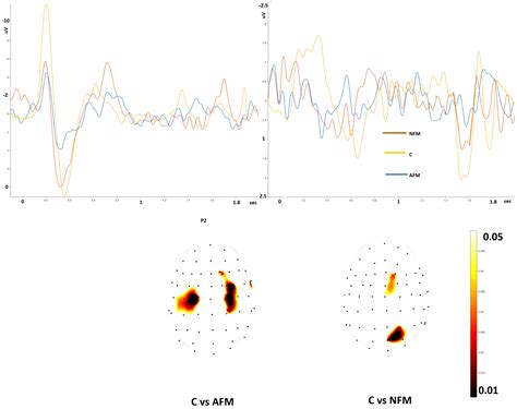 YAP Ultralate Laser-Evoked Responses in Fibromyalgia: A Pilot Study in ...