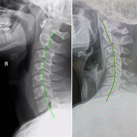 Normal cervical spine x-ray vs. my own : r/XRayPorn