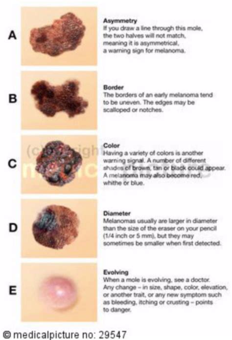 Melanoma Abcde at Steven Hines blog