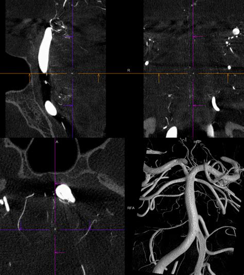 Charcot-Bouchard Aneurysms Of Unusual Size? I Don’t Think They Exist ...
