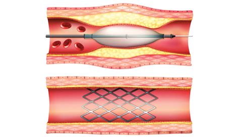 PCI Treatment 的图像结果